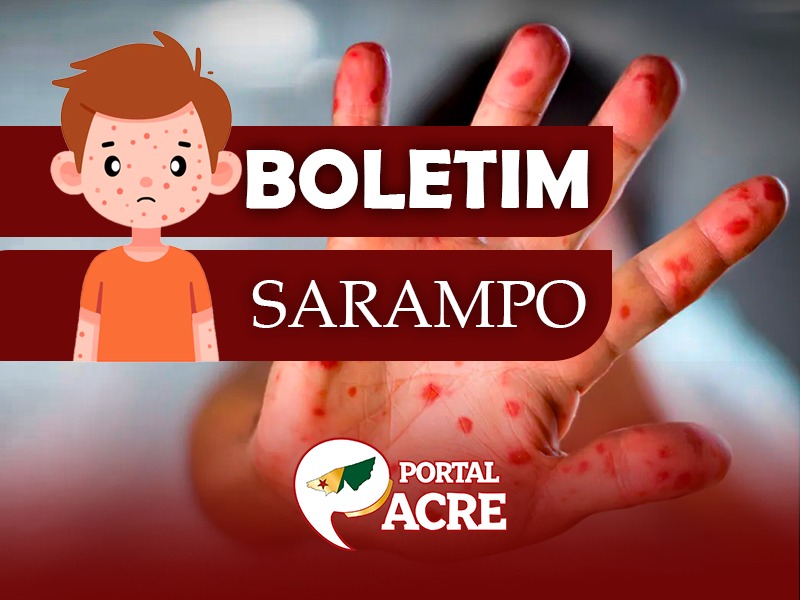 Acre notifica 15 casos suspeitos de sarampo; 4 seguem em investigação, e nenhum foi confirmado